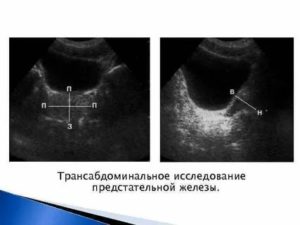 Трансабдоминальное исследование предстательной железы и мочевого пузыря