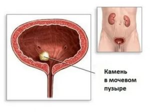 Как отличить песок в мочевом пузыре от цистита