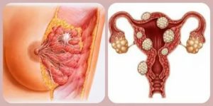 Если есть миома может быть опухоль молочной железы