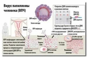 Может ли впч вызвать простатит