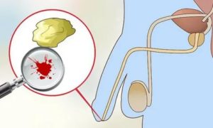 Может ли при простатите появится кровь в сперме