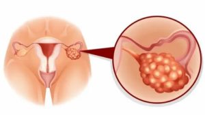 Поликистоз яичников симптомы и лечение при климаксе