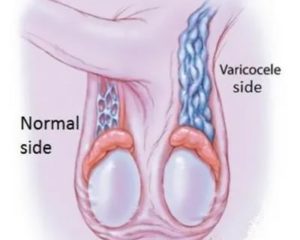 Опухоль яичка после операции на варикоцеле