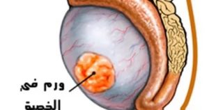 Что если появилась маленькая опухоль на яичке