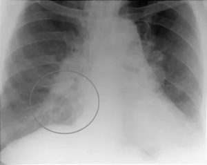 Можно ли увидеть рак молочной железы на флюорографии что