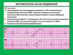 Могут ли быть в месячные экстрасистолы