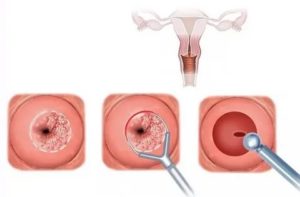 Можно ли делать биопсию шейки матки во время месячных