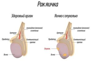 Как определить рак яичка у мужчины в домашних условиях