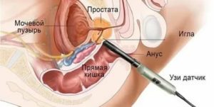 Оптимальным методом для узи предстательной железы является