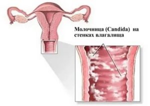 Может ли цистит быть причиной молочницы а молочница цистита