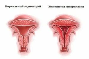 В чем разница между эндометриозом и гиперплазией эндометрия