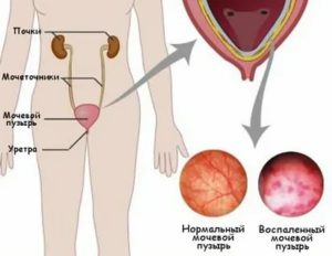 Как определить есть цистит или просто застудилась