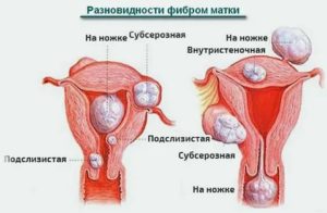 Может ли фиброма матки перейти в рак