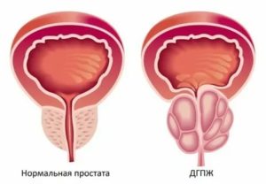 Лечение грибами аденомы предстательной железы