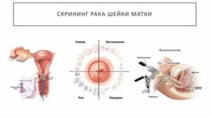 Можно ли обнаружить рак шейки матки при осмотре у гинеколога