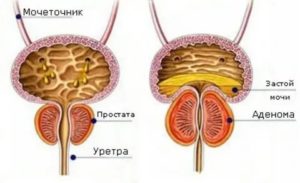 Влияние сиалиса на аденому простаты