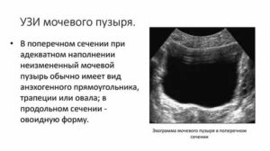 Можно ли выявить цистит по узи