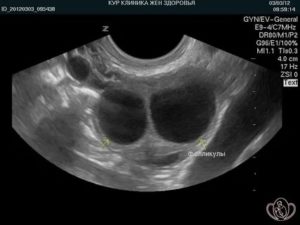 Что значит киста яичника у новорожденного