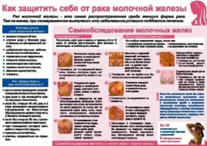 Санбюллетень что такое рак молочной железы
