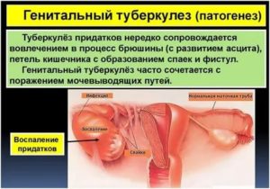 Туберкулез женских половых органов бесплодие