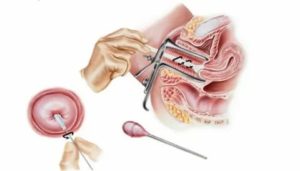 Подготовка к онкоцитологии шейки матки