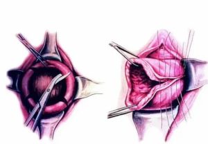 Как называется операция зашивания шейки матки
