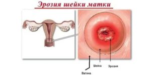 Что такое эрозия шейки матки и может она перейти в рак