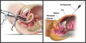Что такое лапароскопия и гистероскопия в гинекологии