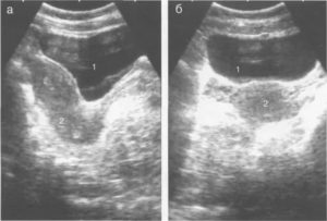 За сколько времени наполняется мочевой пузырь перед узи матки