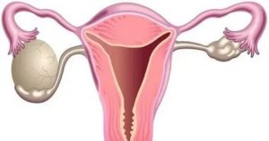 Могут ли быть прыщи при кисте яичника