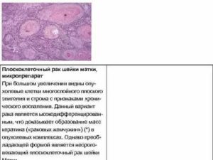 Гистология инвазивной рак шейки матки