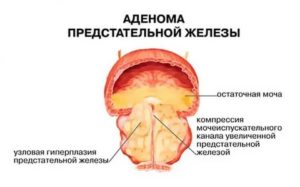 Лечение аденомы предстательной железы солевыми повязками