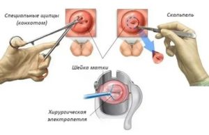 Может ли биопсия быть ошибочной при раке шейки матки