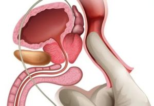Мне 23 года у меня хронический простатит