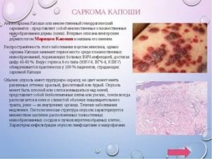 Как выглядит саркома капоши при вич