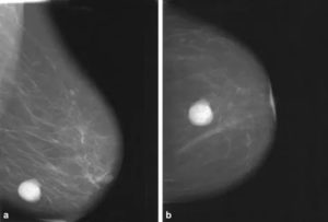 Может ли маммография показать кисты молочной железы