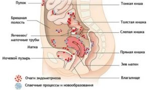 Эндометриоз в кишечнике что делать как лечить