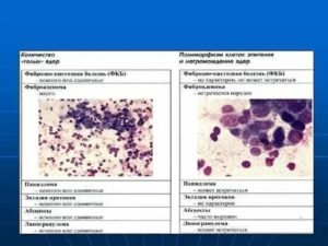 Что такое цитология при раке молочной железы