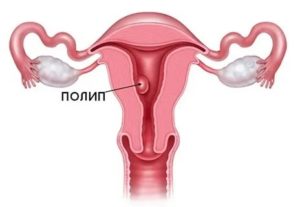 Как выглядит полип эндометрия который выходит с месячными