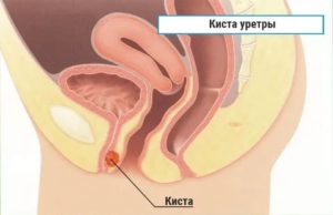 Может ли киста уретры сама рассосаться