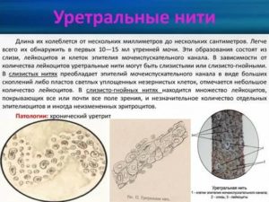 При простатите в моче гнойные нити