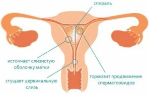 Как забеременеть после спирали советы гинеколога