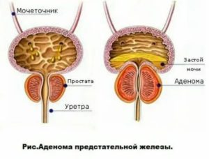 Лечение чагой аденомы предстательной железы