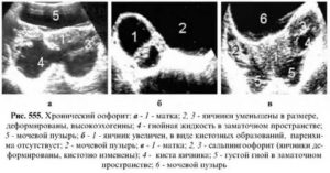 Хронический двухсторонний оофорит на узи