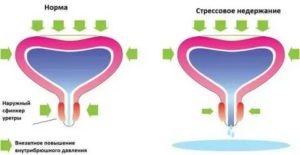 Недержание мочи у мужчин после тур простаты лечение