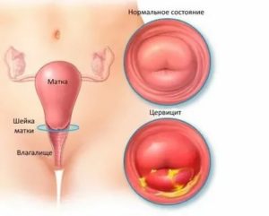 Воспаление цервикального канала при климаксе