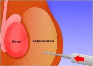 Как вылечить водянку яичка у ребенка без операции народными средствами