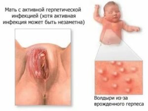 Можно ли перепутать герпес с сифилисом