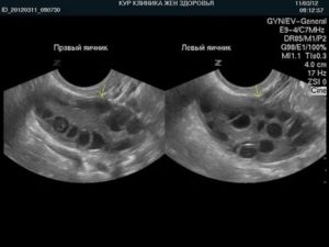 На узи плохо работают яичники