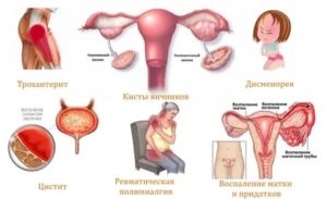 Чем лечить цистит и воспаление придатков